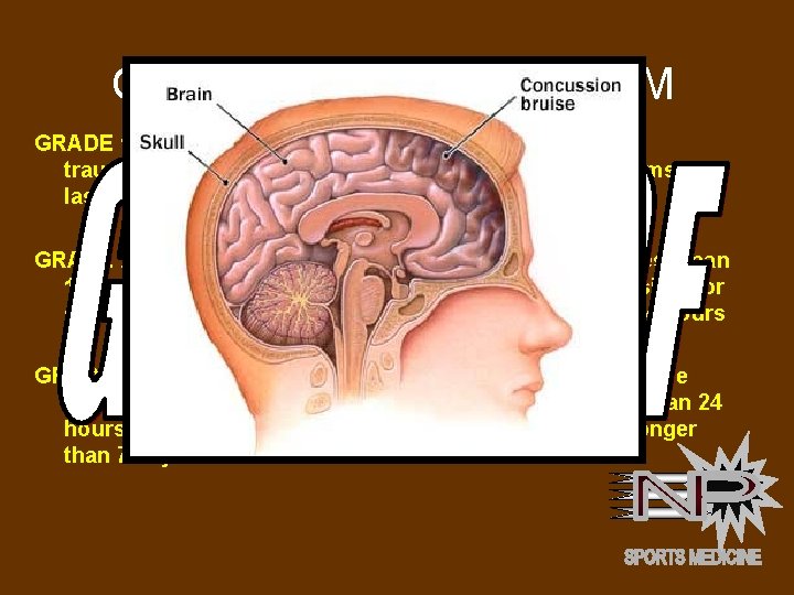 CANTU GRADING SYSTEM GRADE 1 CONCUSSION: No loss of consciousness; post. OF CONCUSSIONS traumatic