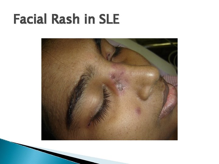 Facial Rash in SLE 