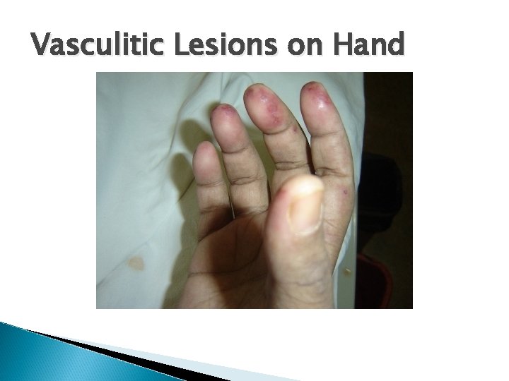 Vasculitic Lesions on Hand 