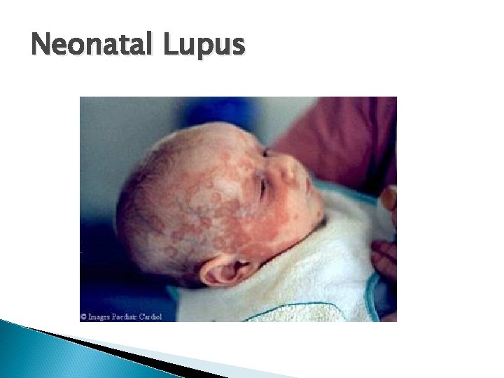 Neonatal Lupus 