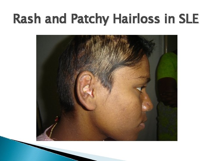 Rash and Patchy Hairloss in SLE 