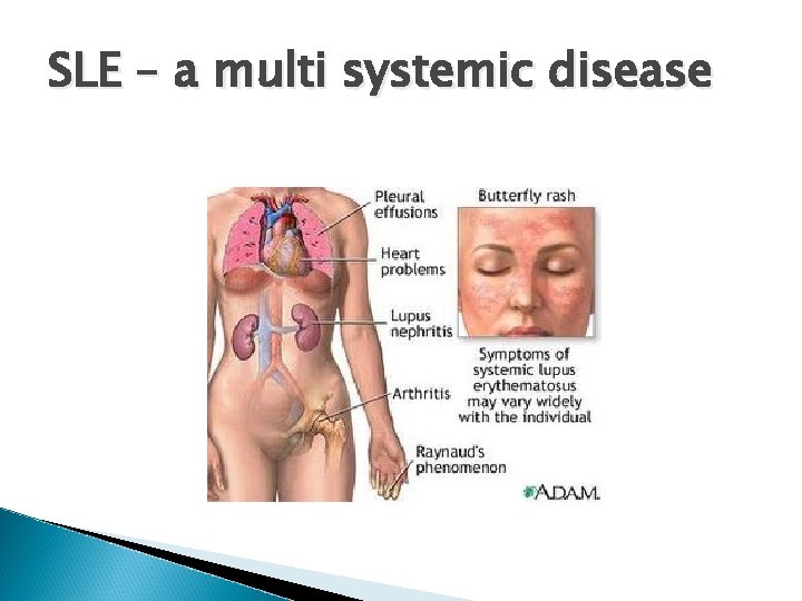 SLE – a multi systemic disease 