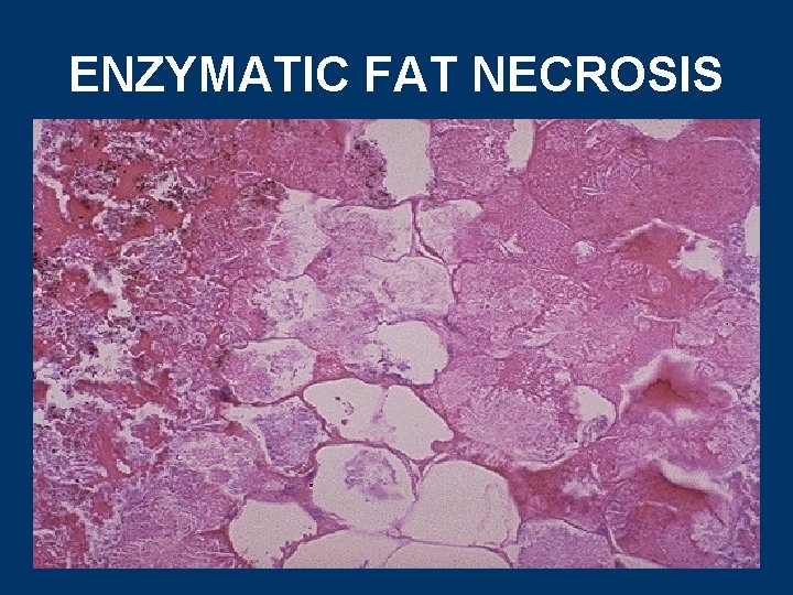 ENZYMATIC FAT NECROSIS 