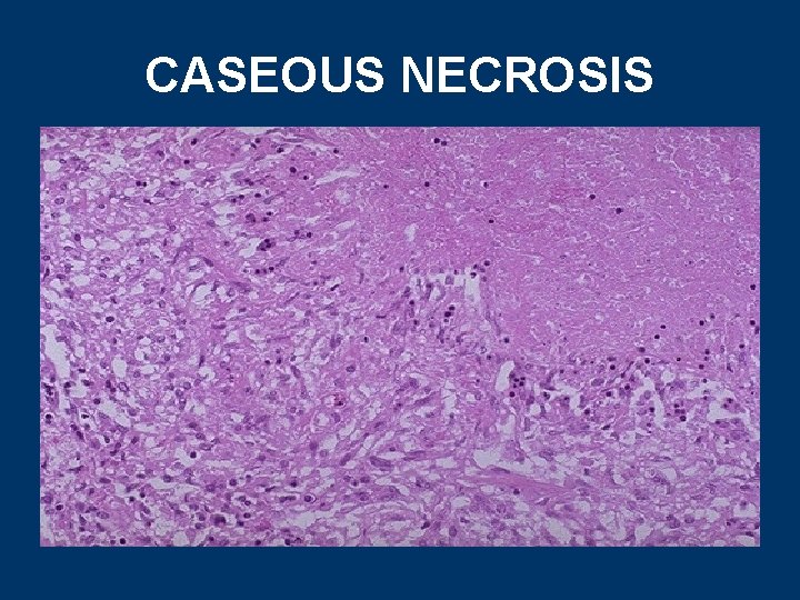 CASEOUS NECROSIS 