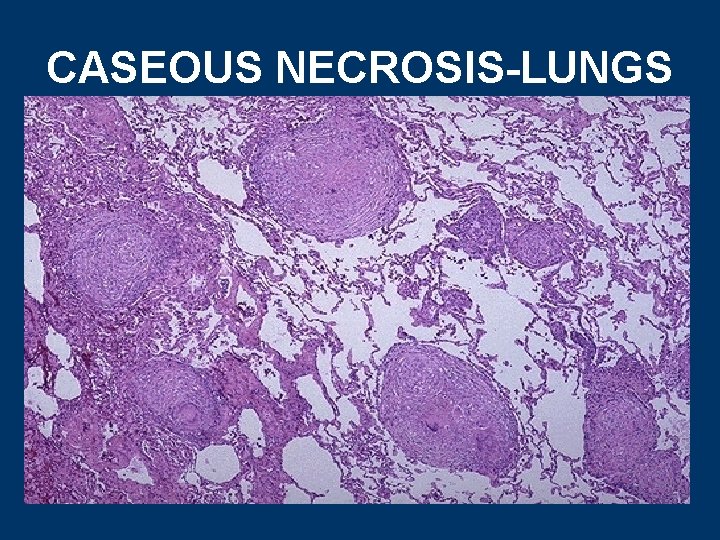 CASEOUS NECROSIS-LUNGS 
