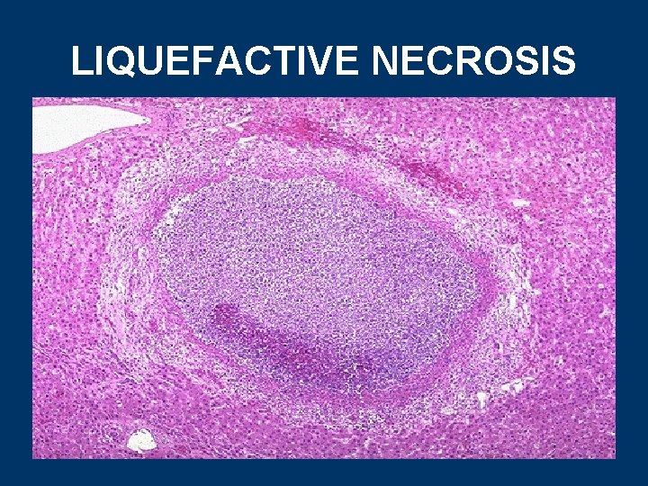 LIQUEFACTIVE NECROSIS 