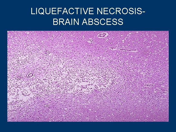 LIQUEFACTIVE NECROSISBRAIN ABSCESS 