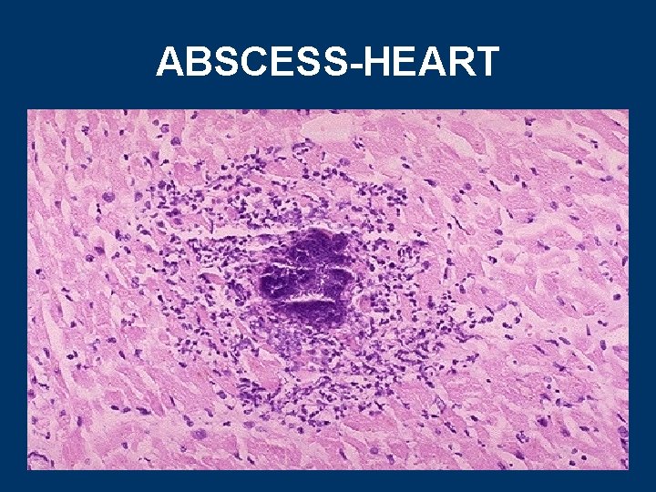 ABSCESS-HEART 