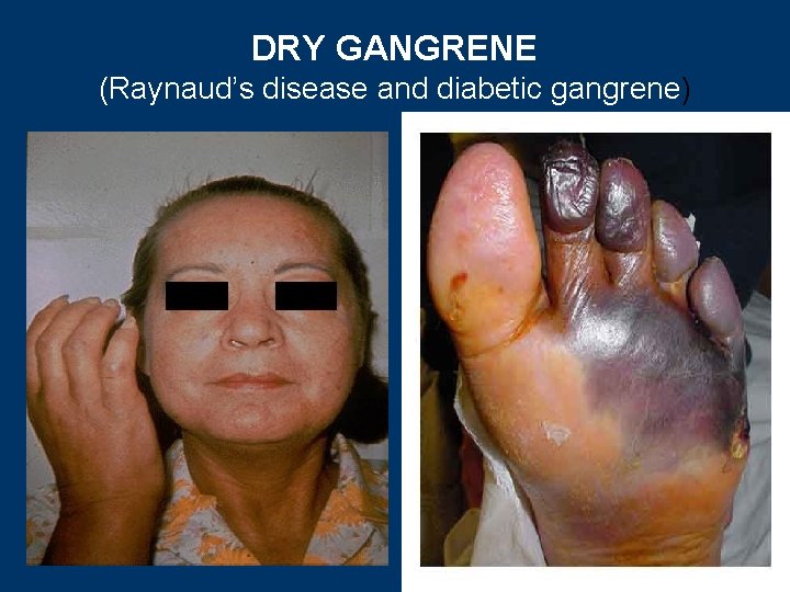 DRY GANGRENE (Raynaud’s disease and diabetic gangrene) 