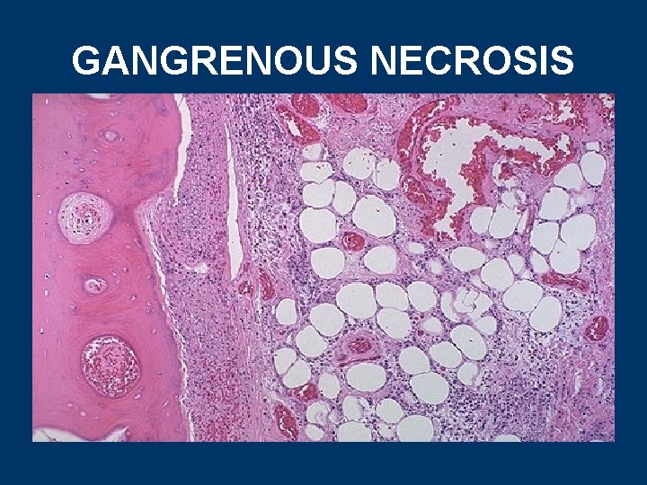 GANGRENOUS NECROSIS 