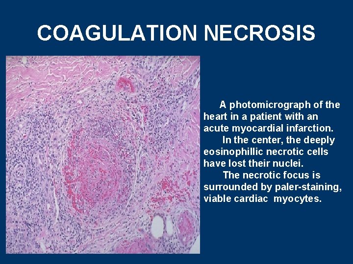 COAGULATION NECROSIS A photomicrograph of the heart in a patient with an acute myocardial