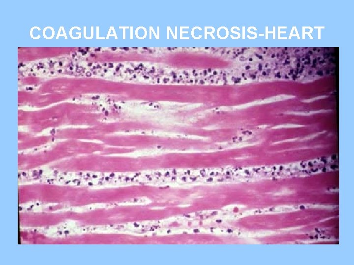 COAGULATION NECROSIS-HEART 