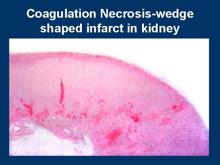 Coagulation Necrosis-wedge shaped infarct in kidney 