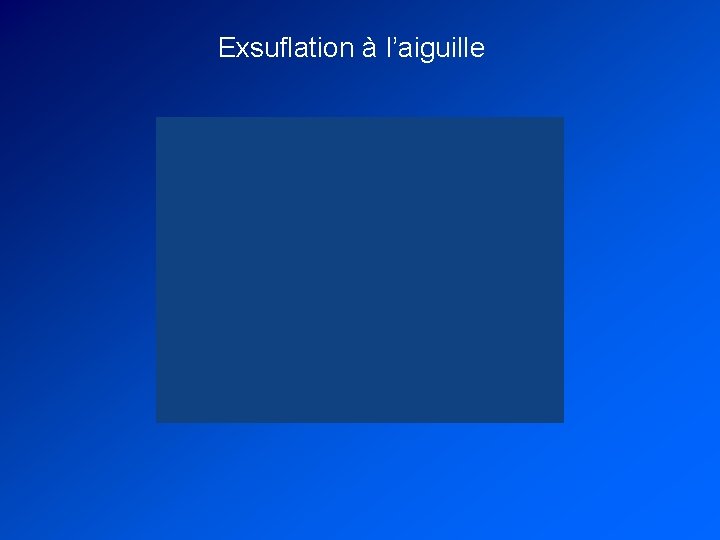 Exsuflation à l’aiguille 