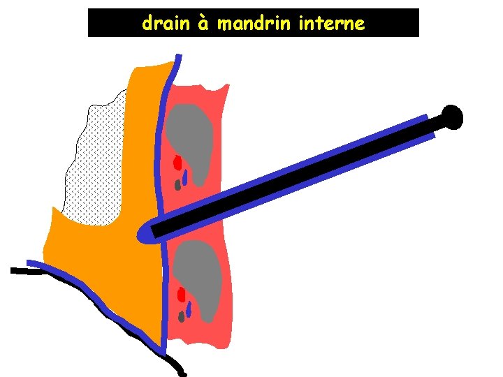 drain à mandrin interne 