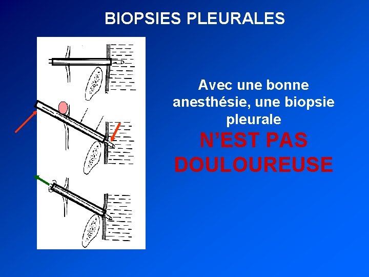 BIOPSIES PLEURALES Avec une bonne anesthésie, une biopsie pleurale N’EST PAS DOULOUREUSE 