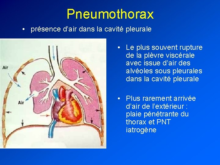 Pneumothorax • présence d’air dans la cavité pleurale • Le plus souvent rupture de