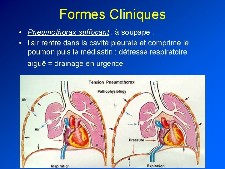 Formes Cliniques • Pneumothorax suffocant : à soupape : • l’air rentre dans la