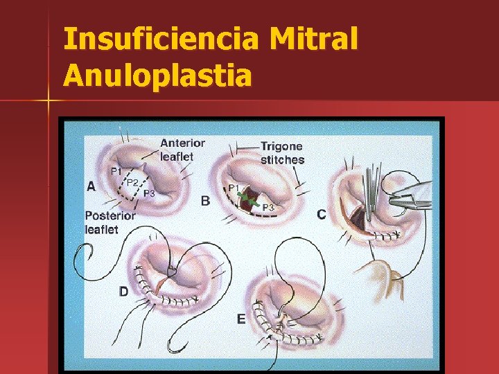 Insuficiencia Mitral Anuloplastia 