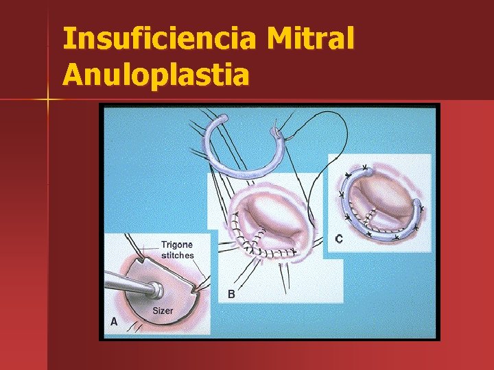 Insuficiencia Mitral Anuloplastia 