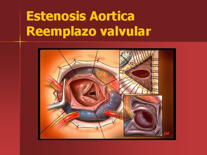 Estenosis Aortica Reemplazo valvular 
