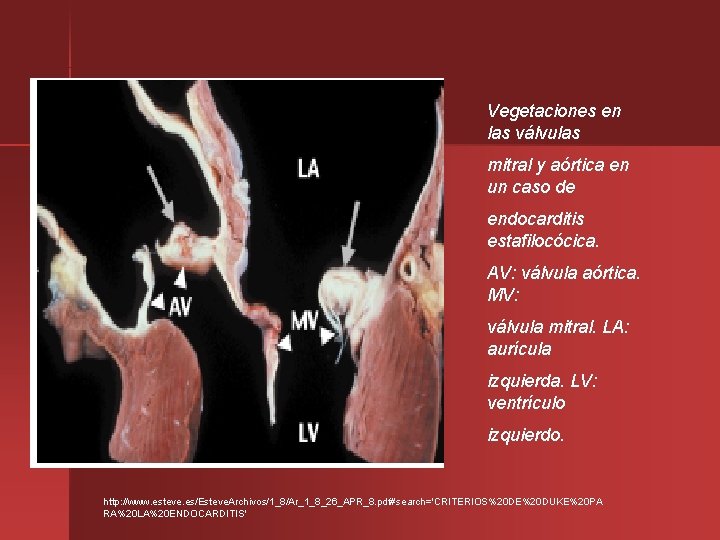 Vegetaciones en las válvulas mitral y aórtica en un caso de endocarditis estafilocócica. AV: