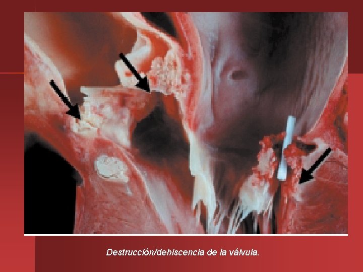 Destrucción/dehiscencia de la válvula. 