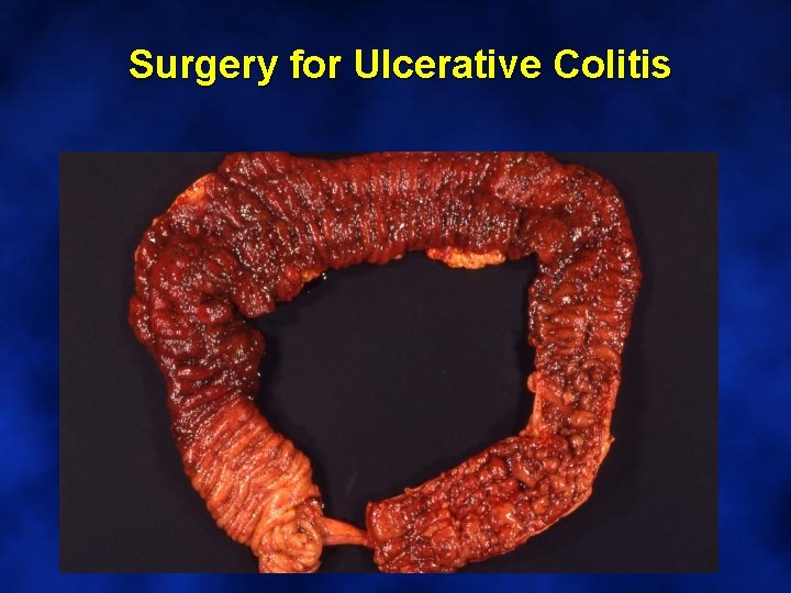 Surgery for Ulcerative Colitis 