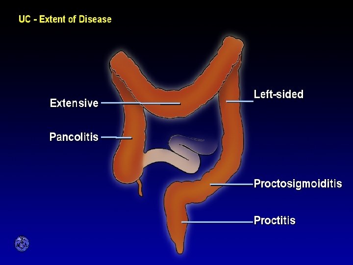 ANATOMIC EXTENT OF ULCERATIVE COLITIS 