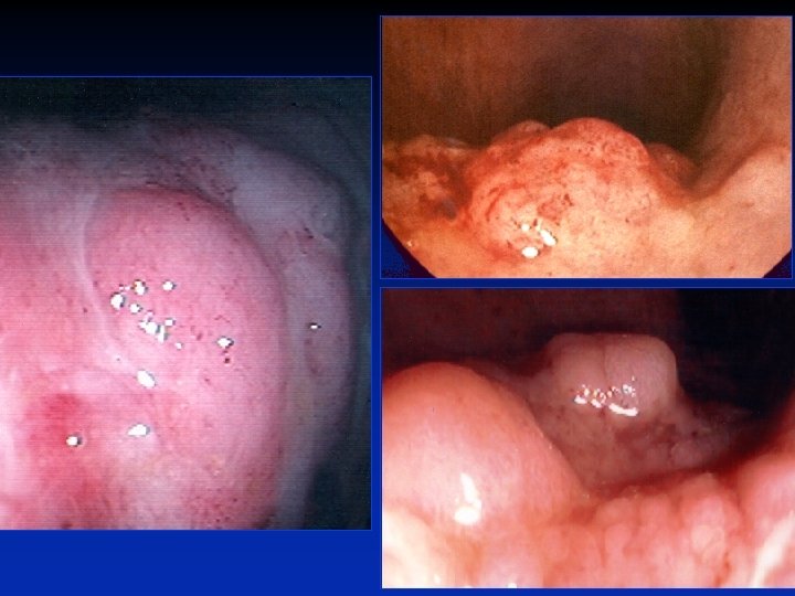 DALMS IN ULCERATIVE COLITIS 