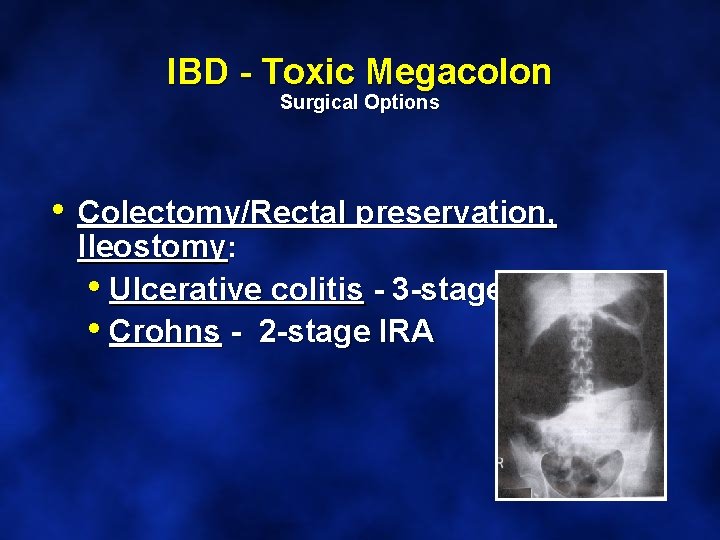 IBD - Toxic Megacolon Surgical Options • Colectomy/Rectal preservation, Ileostomy: • Ulcerative colitis -