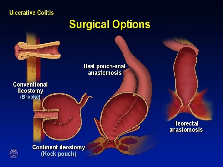 SURGICAL OPTIONS IN ULCERATIVE COLITIS 
