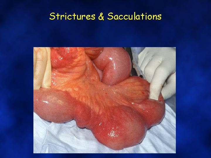 Strictures & Sacculations 