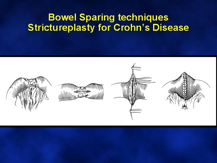 Bowel Sparing techniques Strictureplasty for Crohn’s Disease 