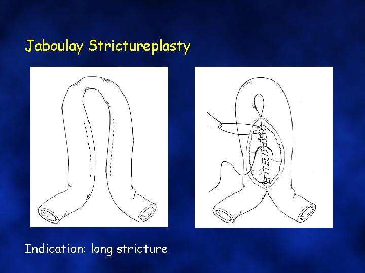Jaboulay Strictureplasty Indication: long stricture 