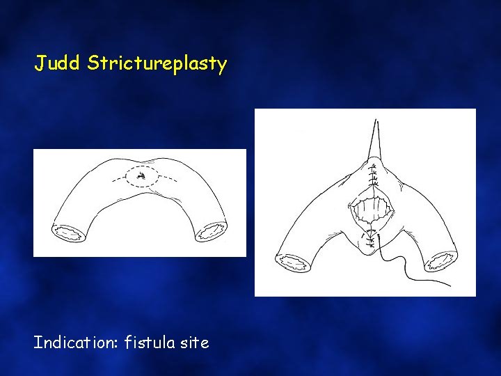 Judd Strictureplasty Indication: fistula site 