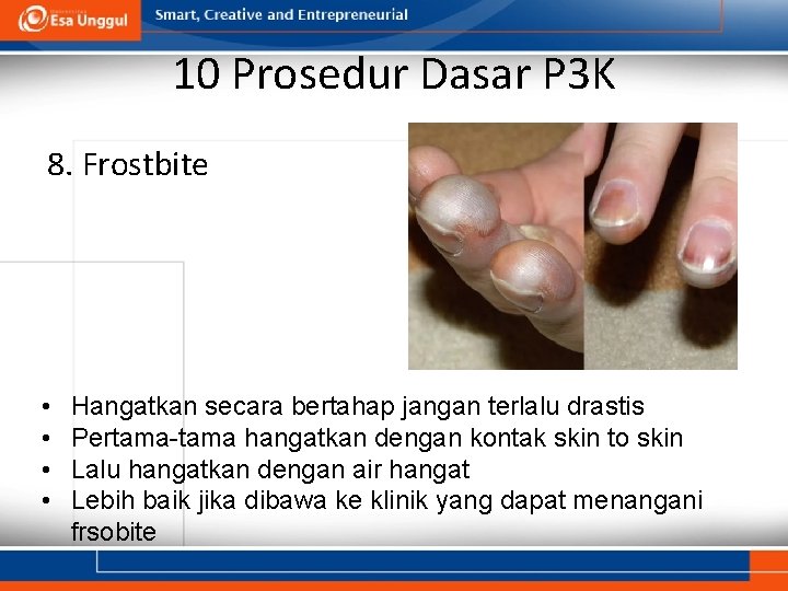 10 Prosedur Dasar P 3 K 8. Frostbite • • Hangatkan secara bertahap jangan