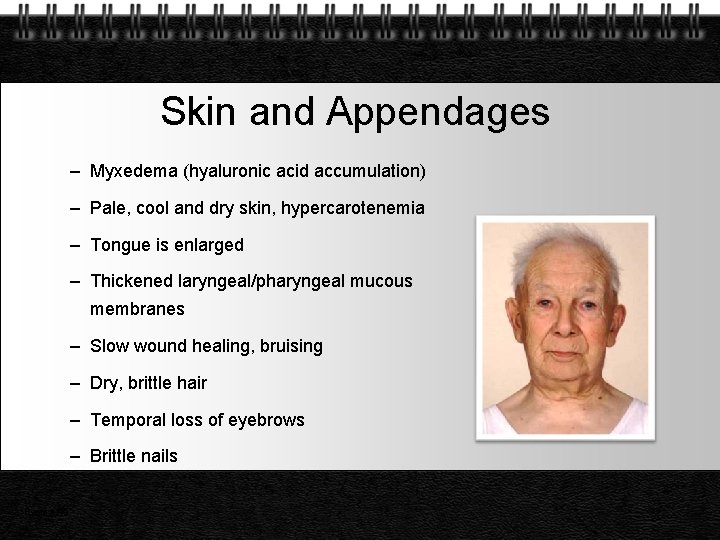 Skin and Appendages – Myxedema (hyaluronic acid accumulation) – Pale, cool and dry skin,