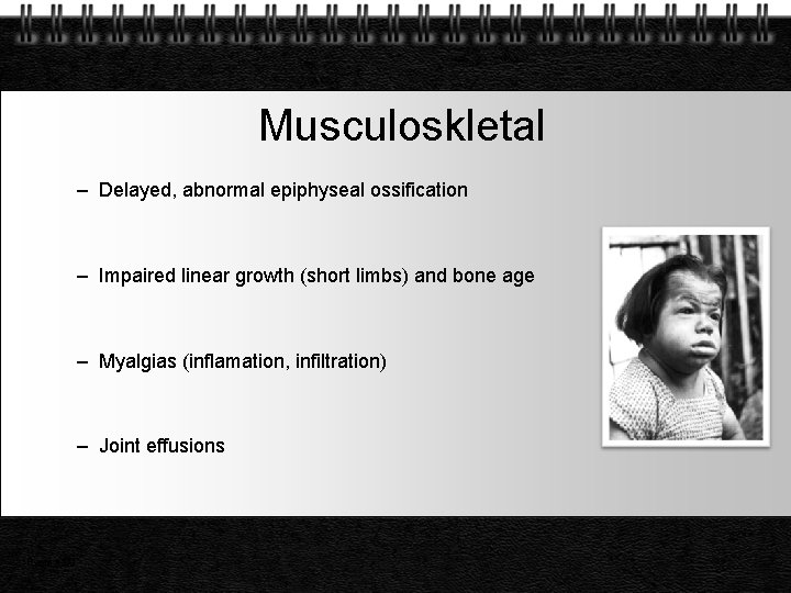 Musculoskletal – Delayed, abnormal epiphyseal ossification – Impaired linear growth (short limbs) and bone