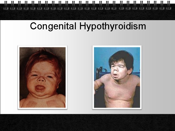 Congenital Hypothyroidism Page 25 