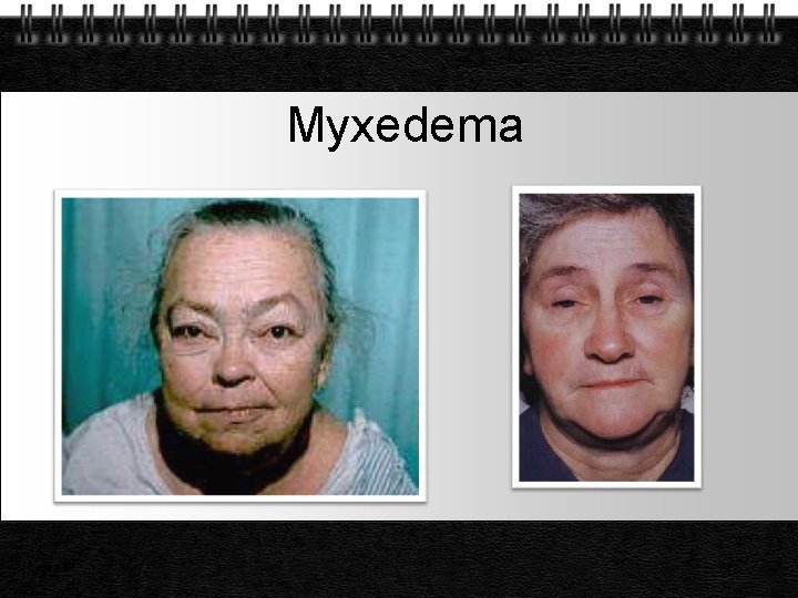 Myxedema Page 27 