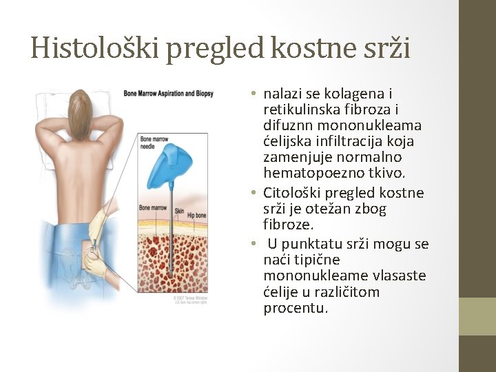 Histološki pregled kostne srži • nalazi se kolagena i retikulinska fibroza i difuznn mononukleama