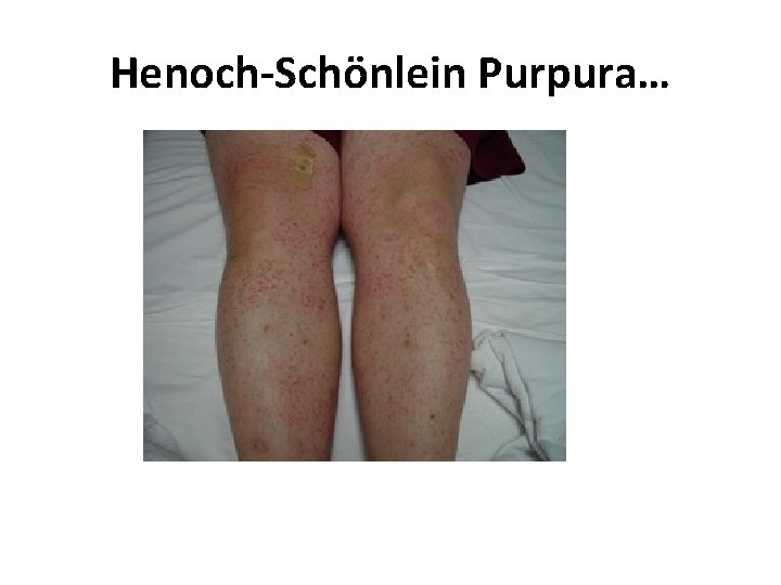 Henoch-Schönlein Purpura… 