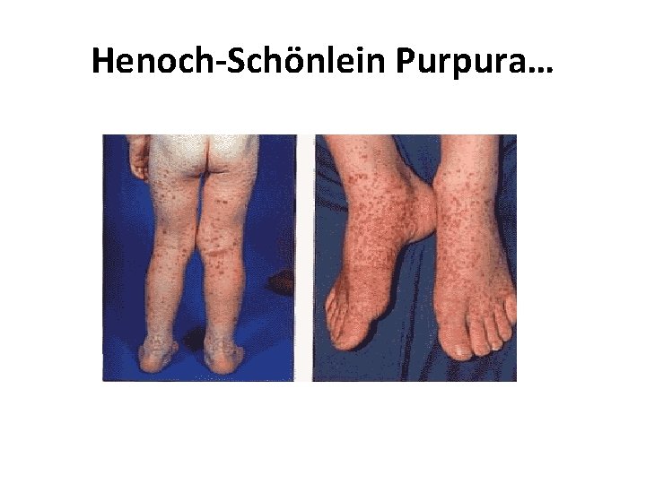 Henoch-Schönlein Purpura… 