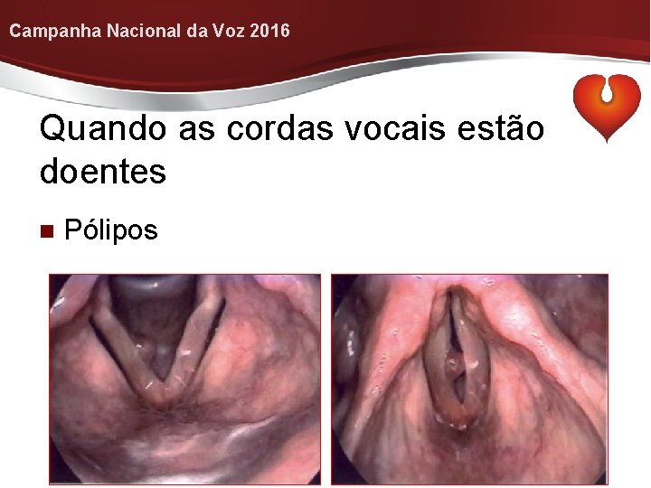 Campanha Nacional da Voz 2016 Quando as cordas vocais estão doentes n Pólipos 