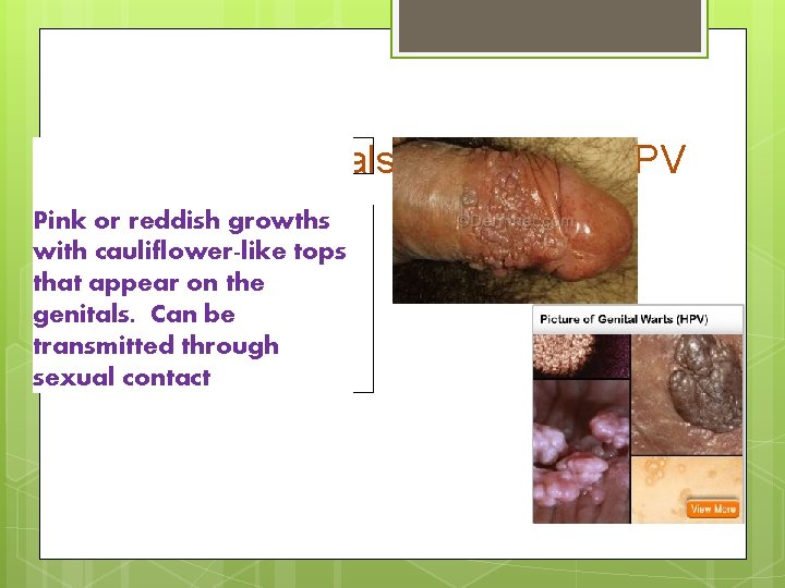 Genital Warts also known as HPV Pink or reddish growths with cauliflower-like tops that