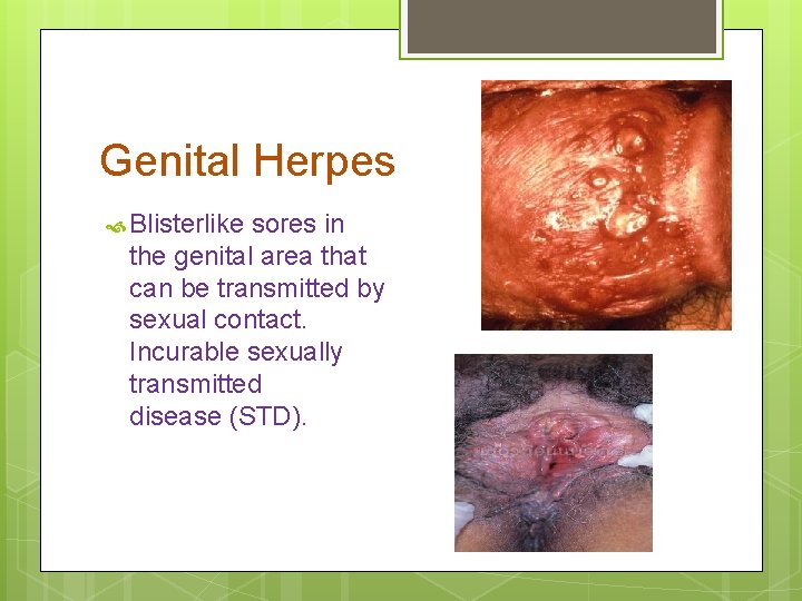 Genital Herpes Blisterlike sores in the genital area that can be transmitted by sexual
