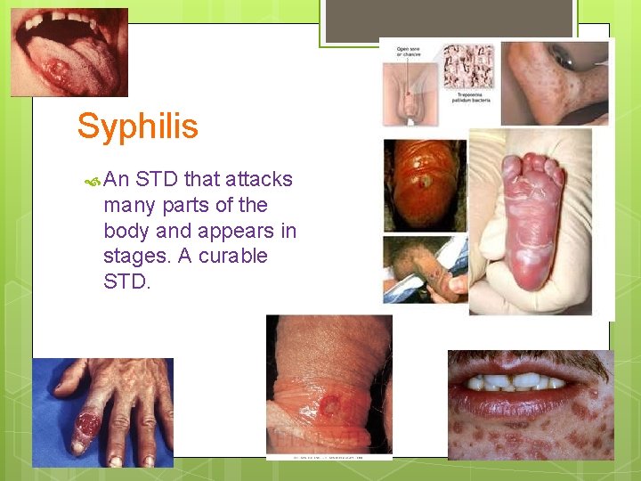 Syphilis An STD that attacks many parts of the body and appears in stages.