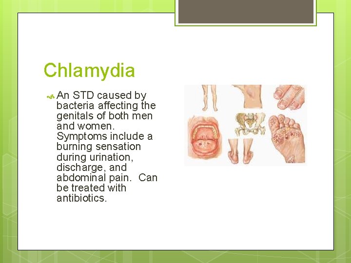 Chlamydia An STD caused by bacteria affecting the genitals of both men and women.