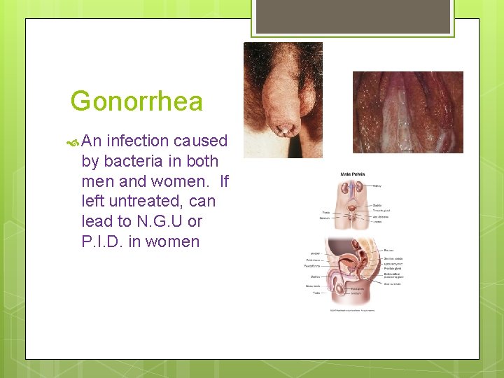 Gonorrhea An infection caused by bacteria in both men and women. If left untreated,